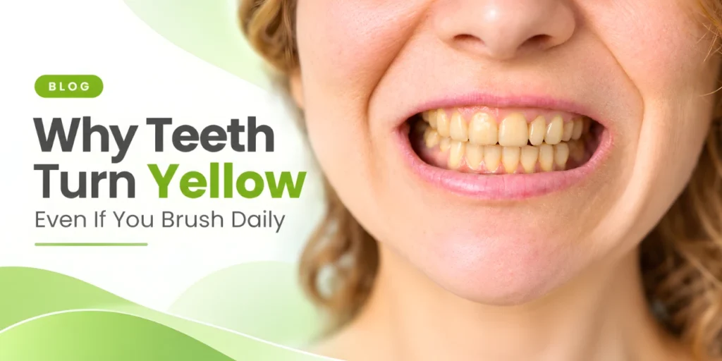 Close-up of yellow teeth illustrating why teeth may turn yellow even with daily brushing.